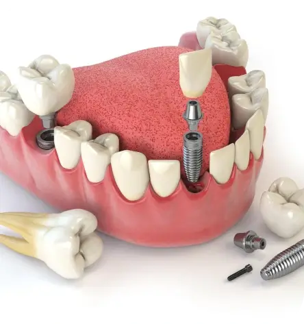 Dental Implants