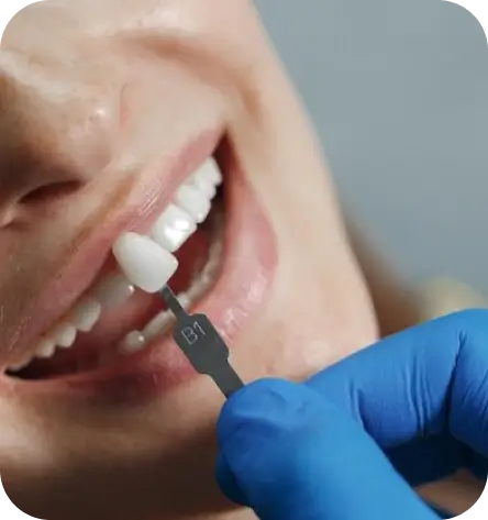 Dental Veneers