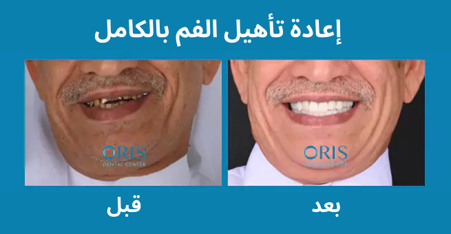 full-mouth-rehabilitation1
