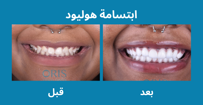 hollywood-smile-before-after2