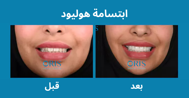 hollywood-smile-before-after3