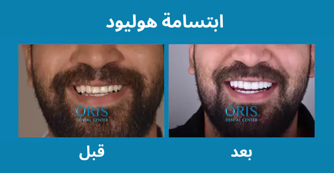 hollywood-smiles-before-after1