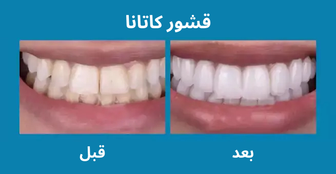 katana-veneers1