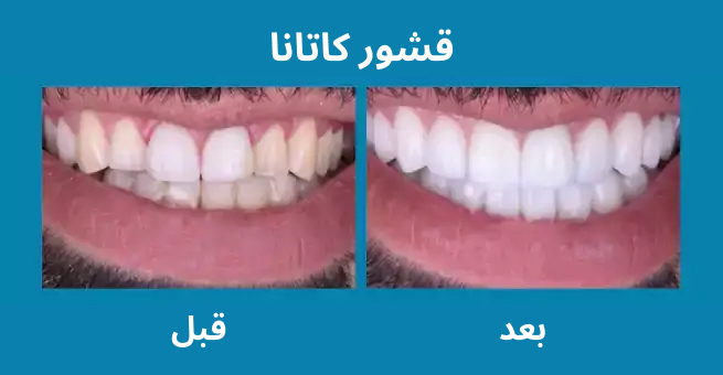 katana-veneers3.webp