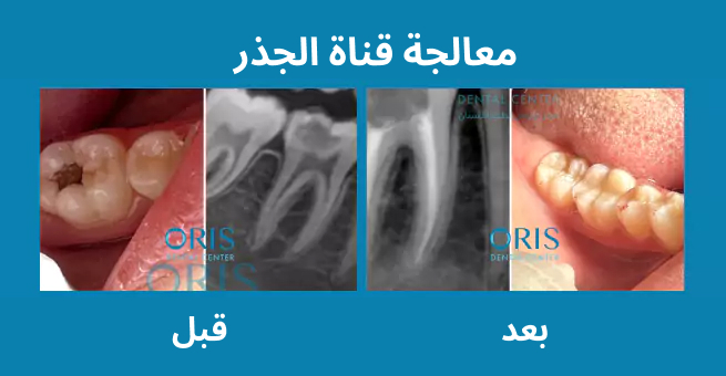 root-canal-before-after1