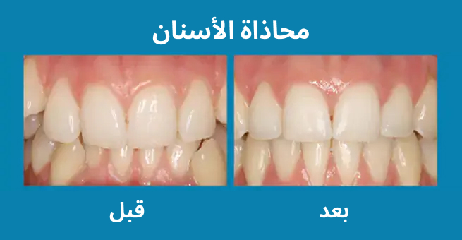 teeth-alignment