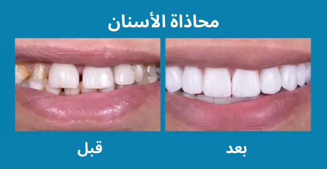 teeth-alignment2